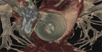 Heartplaque Heartplaque